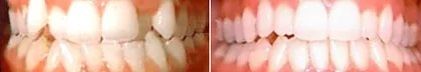 Invisalign corrects for crowding